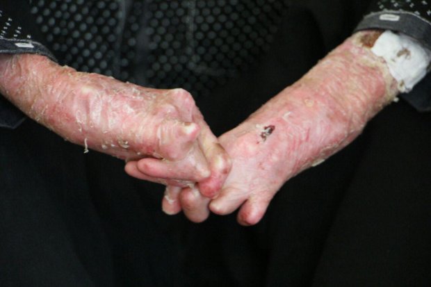 ضرورت اطلاع‌رسانی درباره ازدواج‌های فامیلی و بیماری‌های ژنتیکی